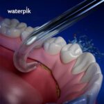 Насадка для імплантного протеза Waterpik (DT-100E) - Зображення 3